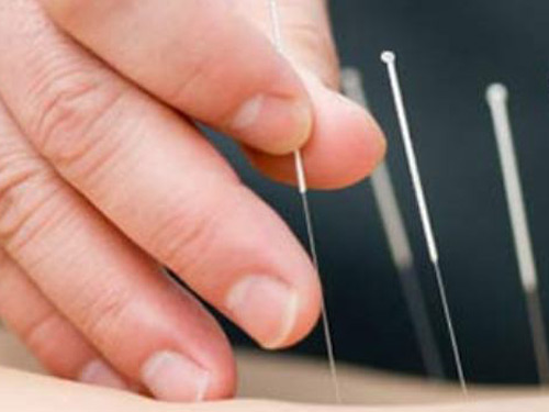 Acupunctura